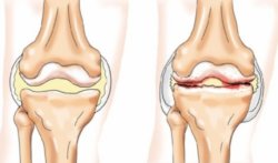 артроз различия